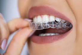 Buy Retainer Online: A Simple and Convenient Way to Maintain Your Smile