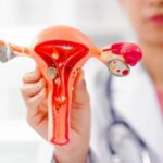 Endometriosis Surgery