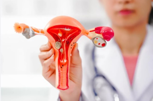 Endometriosis Surgery
