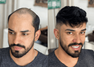 Hair-System-BeforeAfter