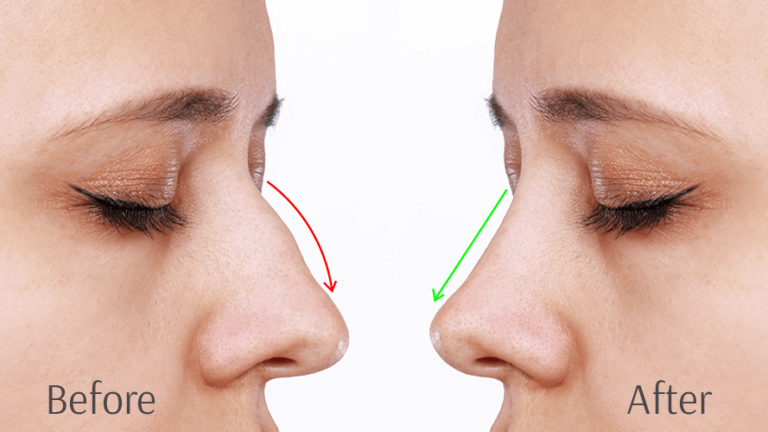 Non-Surgical Rhinoplasty