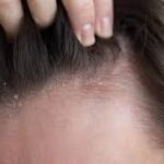 Stress, Dandruff, and Itchy Scalp: What Dermatologists Say