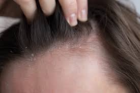 Stress, Dandruff, and Itchy Scalp: What Dermatologists Say