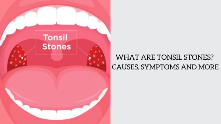 WHAT ARE TONSIL STONES
