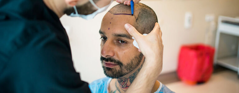 hair Transplant Surgery